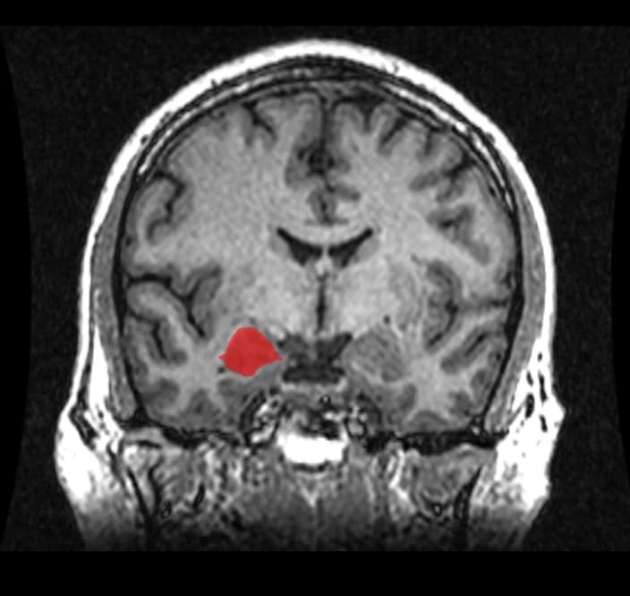 MRI showing the location of the amygdala in the human brain
